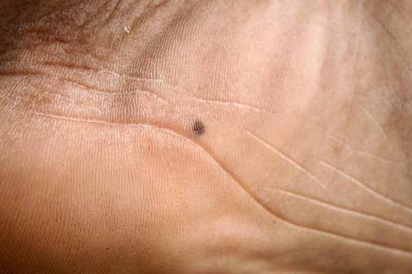 Tumefacciones o lunares